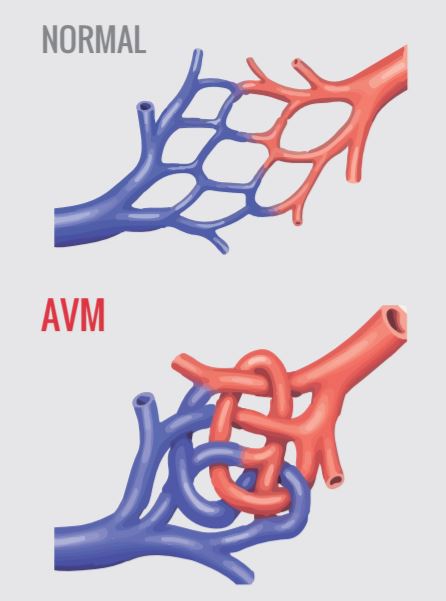 Hva er et arteriovenøse malformasjoner (AVM)?